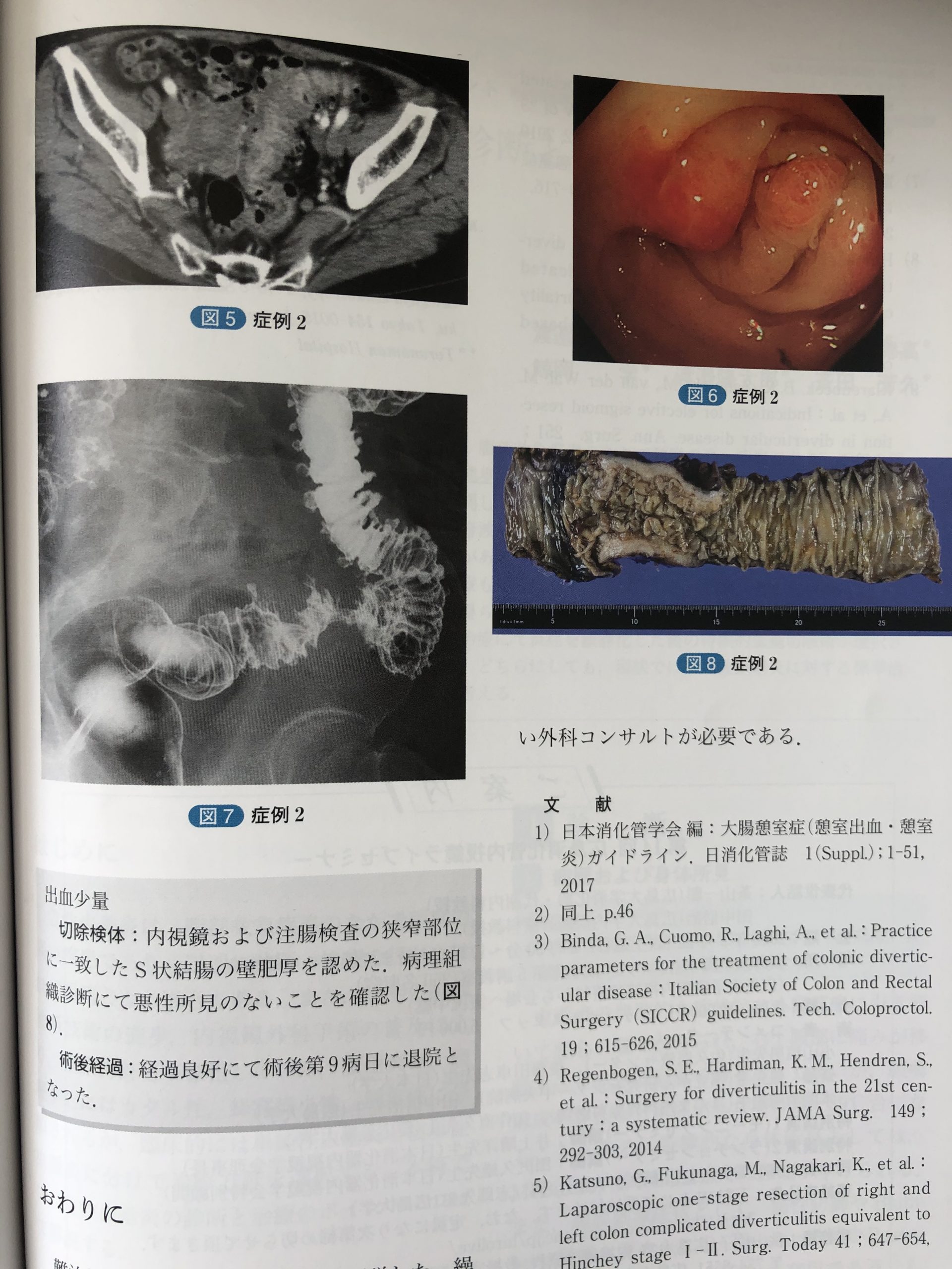 大腸憩室について執筆しました（20年3編目） | 世田谷区桜新町の せたがや内科・消化器クリニック